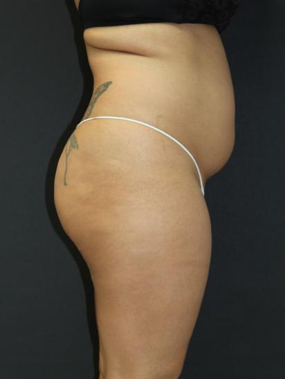 Liposuction Case 6845, Before Treatment, Female Patient, Set 3