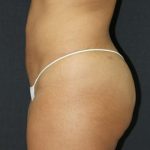 Liposuction Case 6845, After Treatment, Female Patient, Thumbnail 4