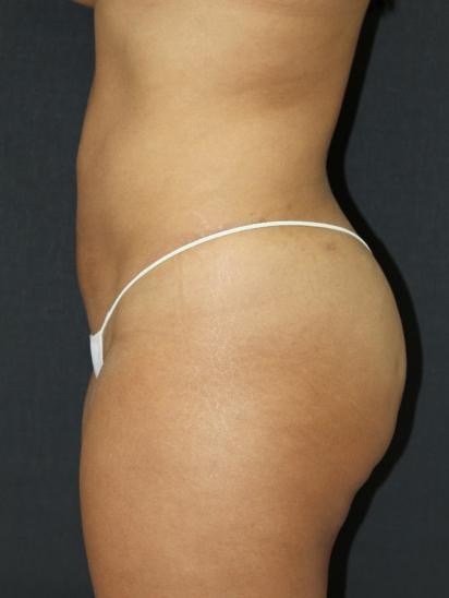 Liposuction Case 6845, After Treatment, Female Patient, Set 4