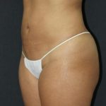 Liposuction Case 6845, After Treatment, Female Patient, Thumbnail 2