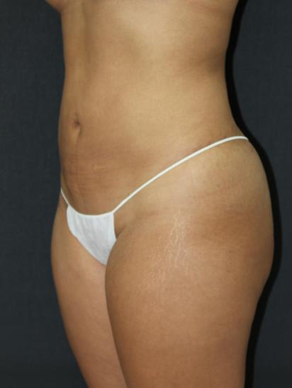 Liposuction Case 6845, After Treatment, Female Patient, Set 2