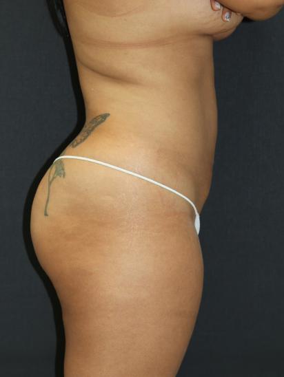 Liposuction Case 6845, After Treatment, Female Patient, Set 3