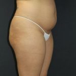 Liposuction Case 6845, Before Treatment, Female Patient, Thumbnail 6