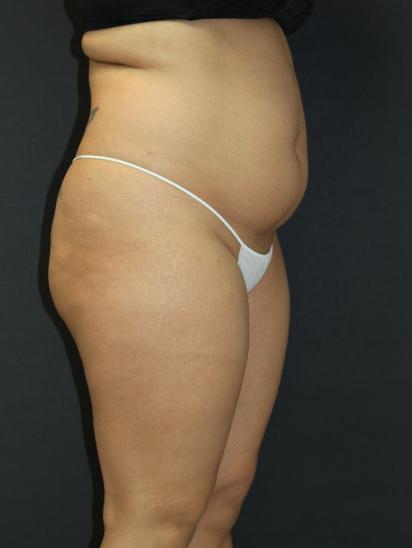 Liposuction Case 6845, Before Treatment, Female Patient, Set 6