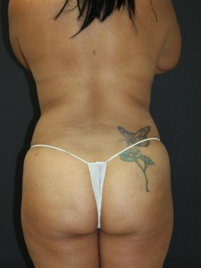 Liposuction Case 6845, After Treatment, Female Patient, Set 5