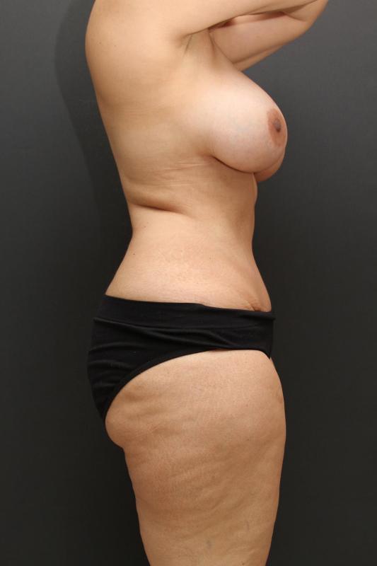 Mommy Makeover Case 6846, After Treatment, Female Patient, Set 3