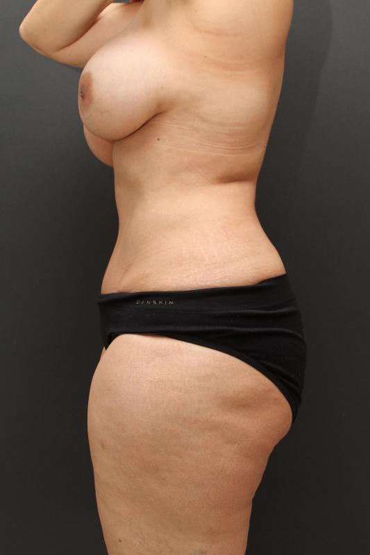 Mommy Makeover Case 6846, After Treatment, Female Patient, Set 5