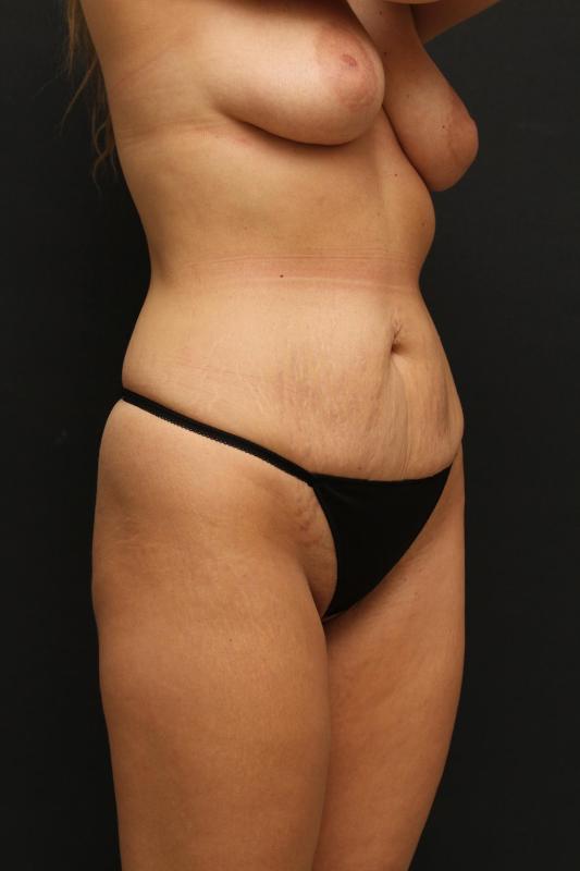 Mommy Makeover Case 6847, Before Treatment, Female Patient, Set 2