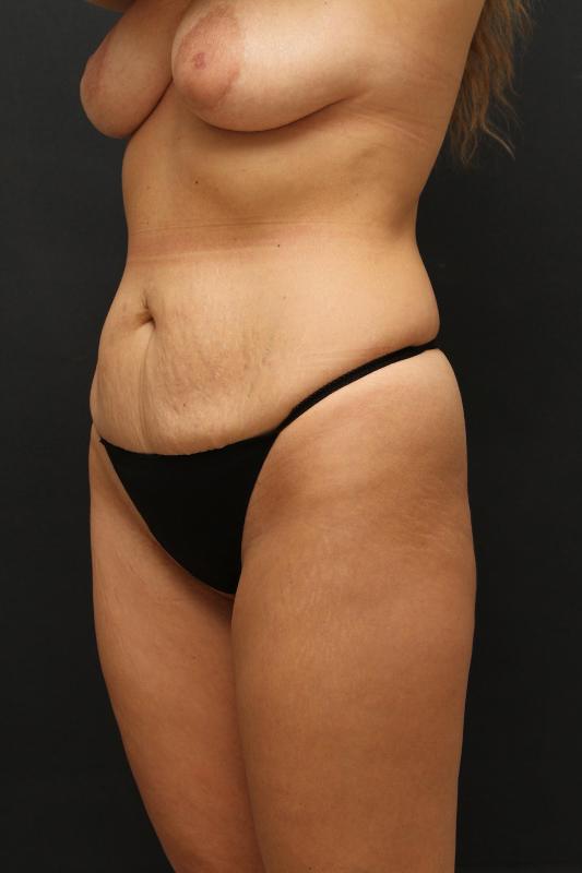 Mommy Makeover Case 6847, Before Treatment, Female Patient, Set 5