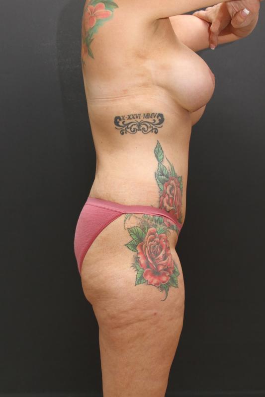 Mommy Makeover Case 6848, After Treatment, Female Patient, Set 3