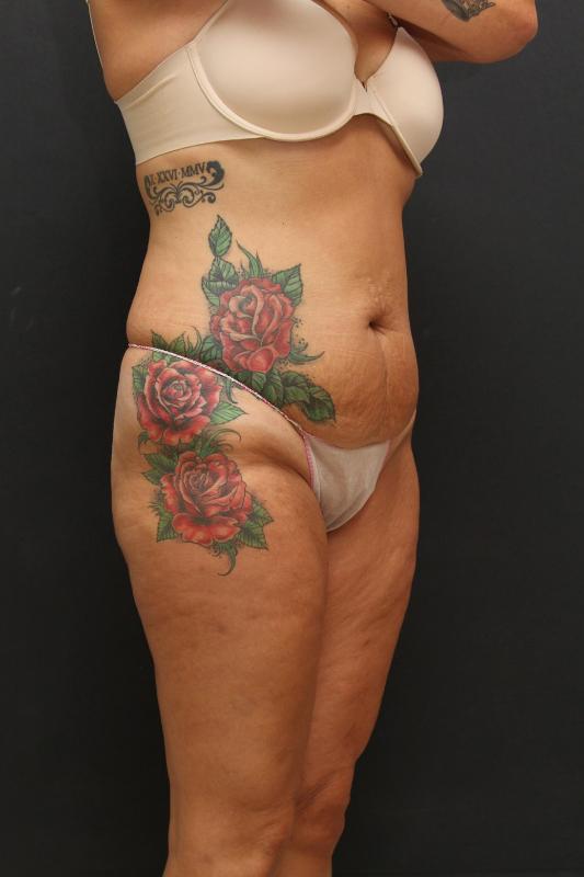 Mommy Makeover Case 6848, Before Treatment, Female Patient, Set 2