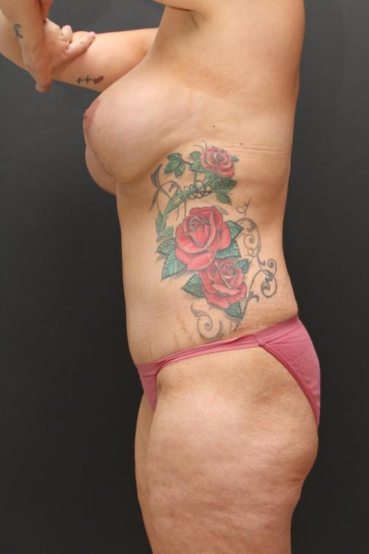 Mommy Makeover Case 6848, After Treatment, Female Patient, Set 4