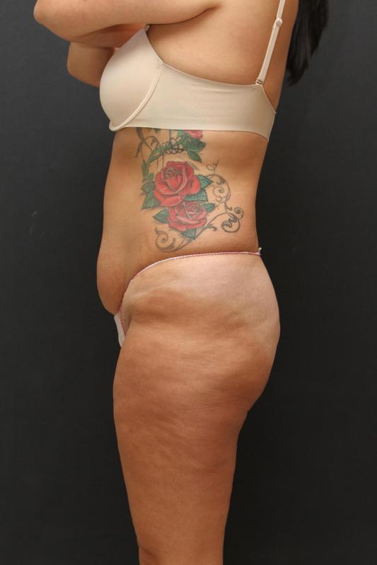 Mommy Makeover Case 6848, Before Treatment, Female Patient, Set 4