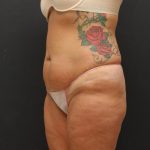 Mommy Makeover Case 6848, Before Treatment, Female Patient, Thumbnail 5