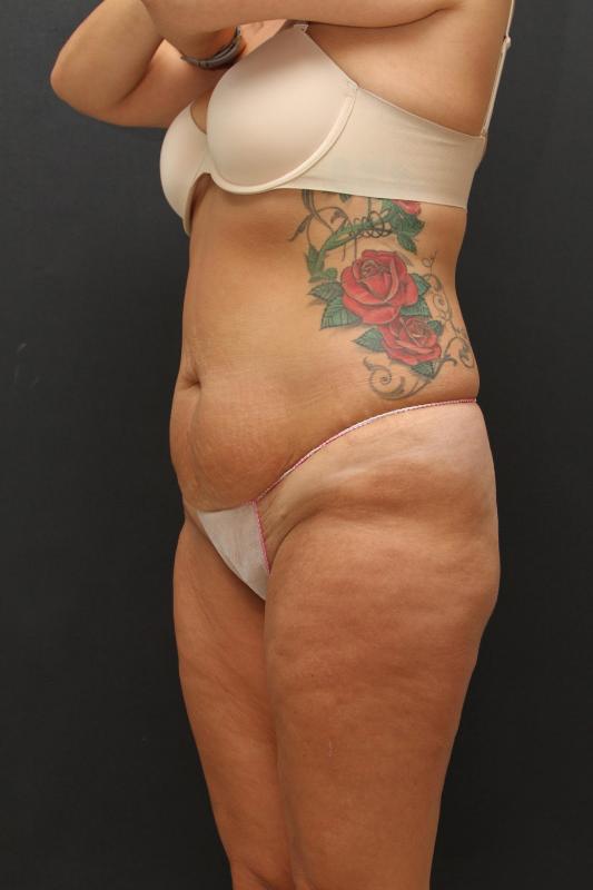 Mommy Makeover Case 6848, Before Treatment, Female Patient, Set 5