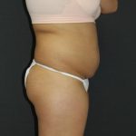 Mommy Makeover Case 6849, Before Treatment, Female Patient, Thumbnail 3