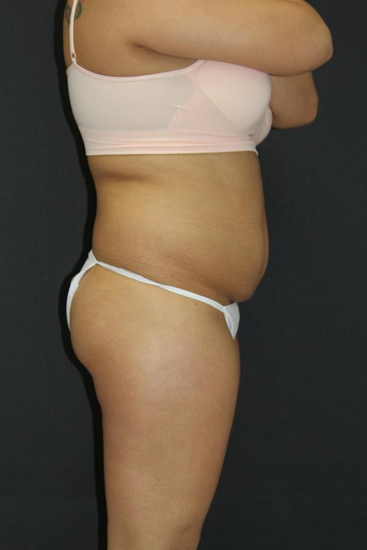 Mommy Makeover Case 6849, Before Treatment, Female Patient, Set 3