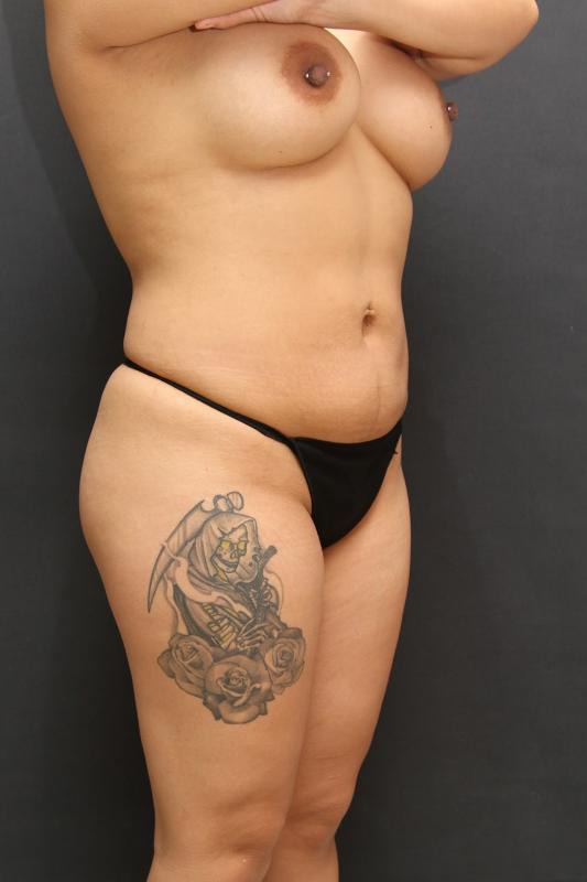 Mommy Makeover Case 6849, After Treatment, Female Patient, Set 2