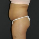 Mommy Makeover Case 6849, Before Treatment, Female Patient, Thumbnail 4