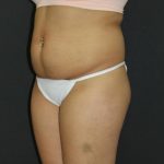Mommy Makeover Case 6849, Before Treatment, Female Patient, Thumbnail 5