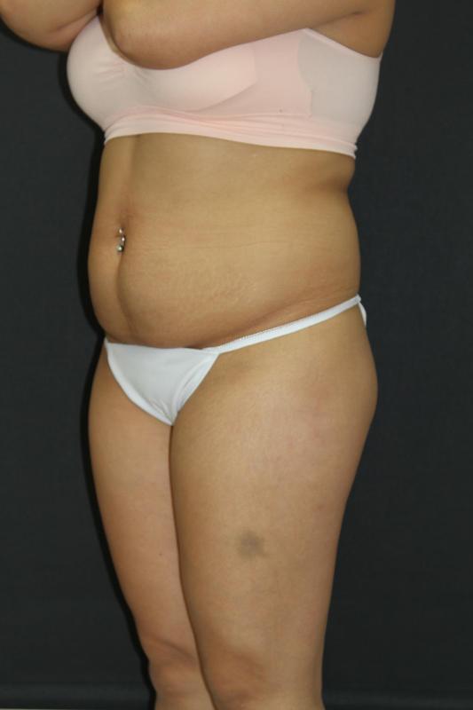Mommy Makeover Case 6849, Before Treatment, Female Patient, Set 5