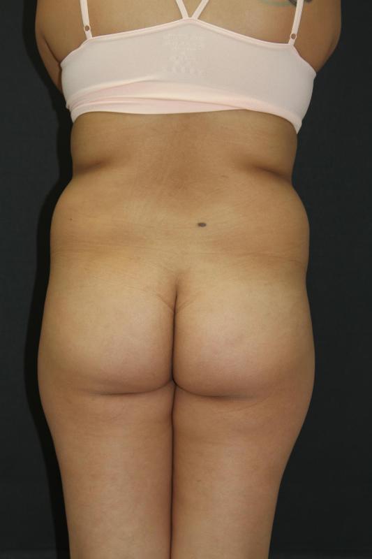 Mommy Makeover Case 6849, Before Treatment, Female Patient, Set 8