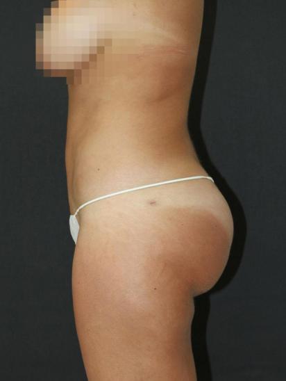 Liposuction Case 6850, After Treatment, Female Patient, Set 2