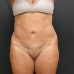 Liposuction Case 6851, After Treatment, Female Patient, Thumbnail 1