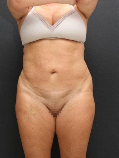 Main Photo Gallery, Case 6851, After Treatment