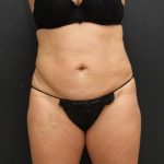 Liposuction Case 6851, Before Treatment, Female Patient, Thumbnail 1