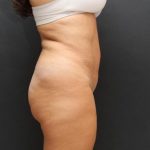 Liposuction Case 6851, After Treatment, Female Patient, Thumbnail 5