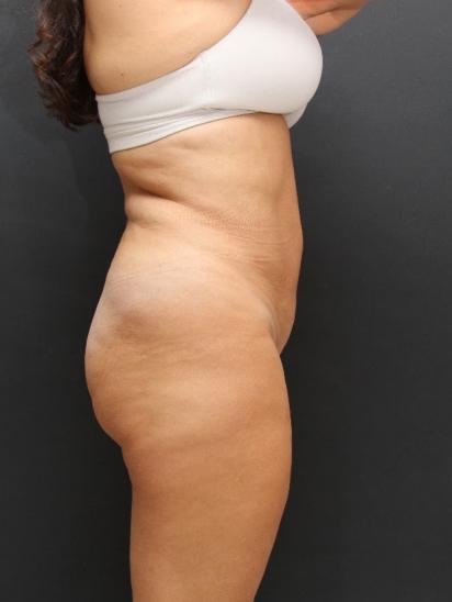 Liposuction Case 6851, After Treatment, Female Patient, Set 5