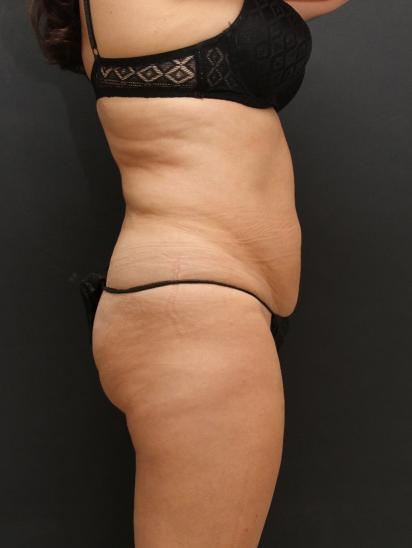 Liposuction Case 6851, Before Treatment, Female Patient, Set 5