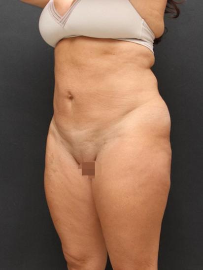 Liposuction Case 6851, After Treatment, Female Patient, Set 2