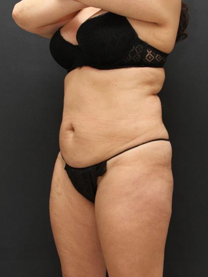 Liposuction Case 6851, Before Treatment, Female Patient, Set 2