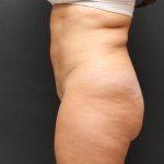 Liposuction Case 6851, After Treatment, Female Patient, Thumbnail 3