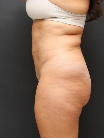 Liposuction Case 6851, After Treatment, Female Patient, Set 3