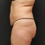 Liposuction Case 6851, Before Treatment, Female Patient, Thumbnail 3