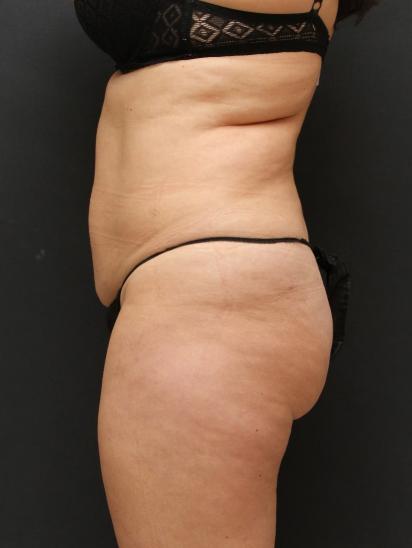 Liposuction Case 6851, Before Treatment, Female Patient, Set 3