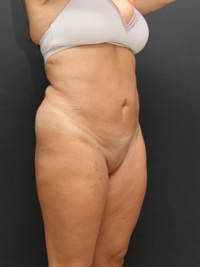 Liposuction Case 6851, After Treatment, Female Patient, Set 4
