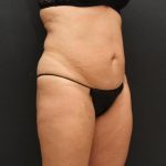 Liposuction Case 6851, Before Treatment, Female Patient, Thumbnail 4