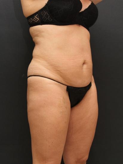 Liposuction Case 6851, Before Treatment, Female Patient, Set 4