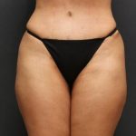 Liposuction Case 6852, After Treatment, Female Patient, Thumbnail 1