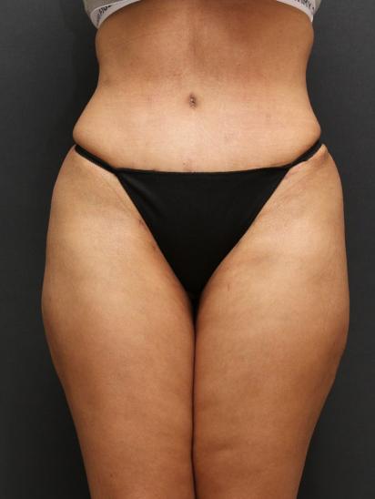 Liposuction After Photo