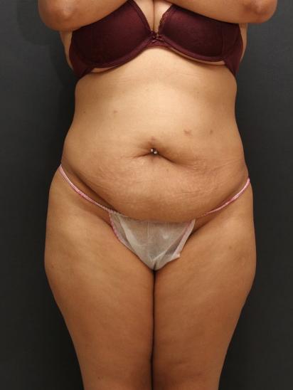 Liposuction Before Photo