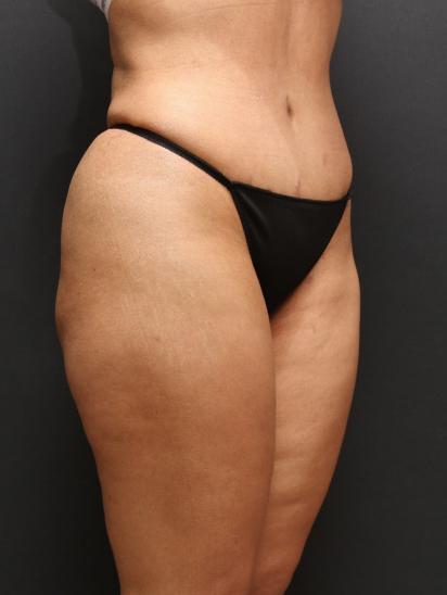 Liposuction Case 6852, After Treatment, Female Patient, Set 4