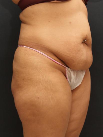 Liposuction Case 6852, Before Treatment, Female Patient, Set 4