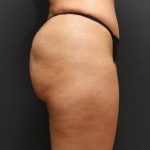 Liposuction Case 6852, After Treatment, Female Patient, Thumbnail 5