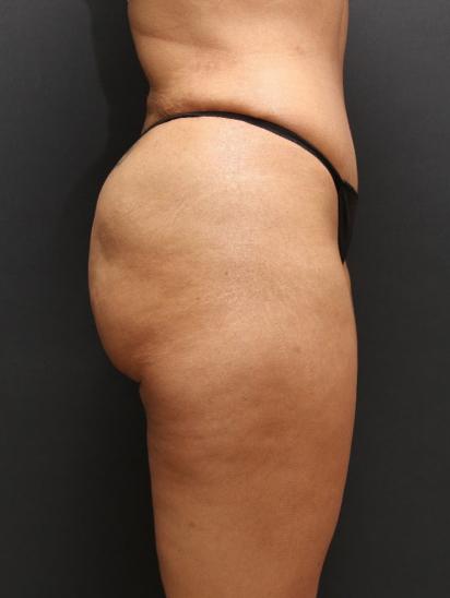 Liposuction Case 6852, After Treatment, Female Patient, Set 5