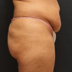 Liposuction Case 6852, Before Treatment, Female Patient, Thumbnail 5